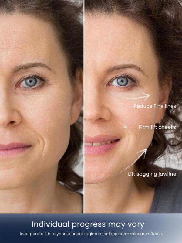 Skin Tightening Device - Image 2